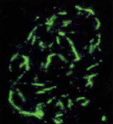 Distribution of Promyelocytic (PML)