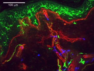 3 color IHC. Human thigh skin Langerhans cells 